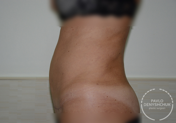 surgery_after