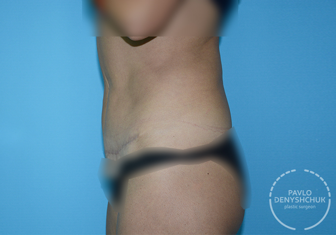 surgery_after
