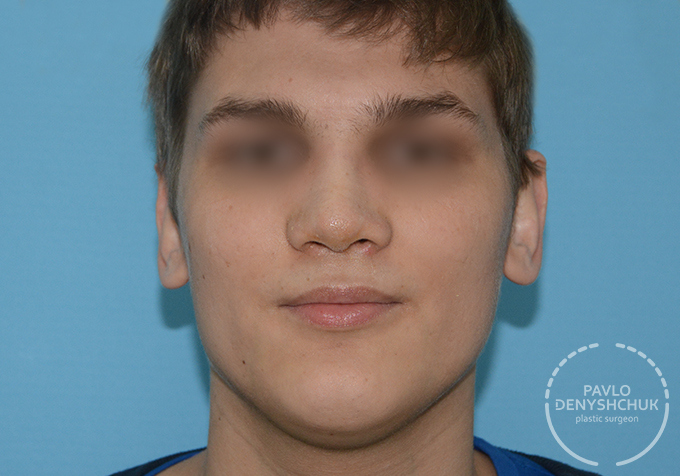 surgery_after
