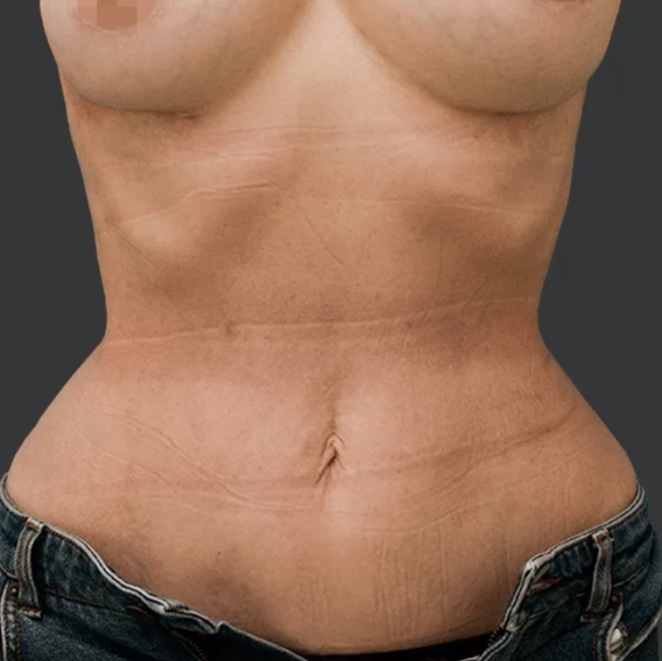surgery_after